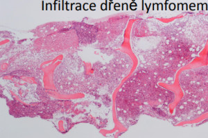 Kazuistika pacientky s atypickým průběhem folikulárního lymfomu