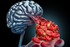Trombektomie je vysoce účinná u velkých ischemických cévních mozkových příhod