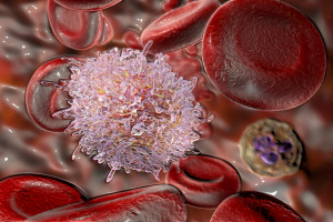 Význam minimální reziduální nemoci u chronické lymfocytární leukémie