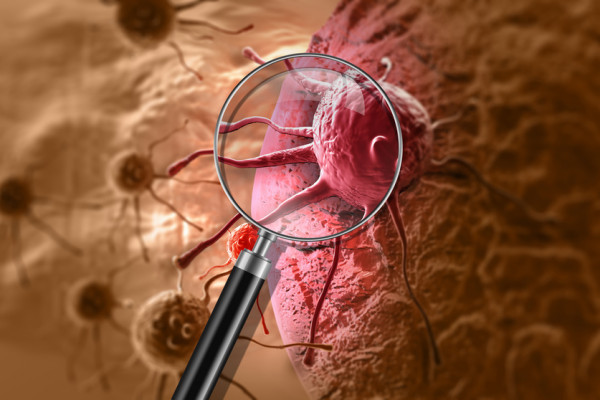 Souhrn klíčových změn z hematoonkologické praxe